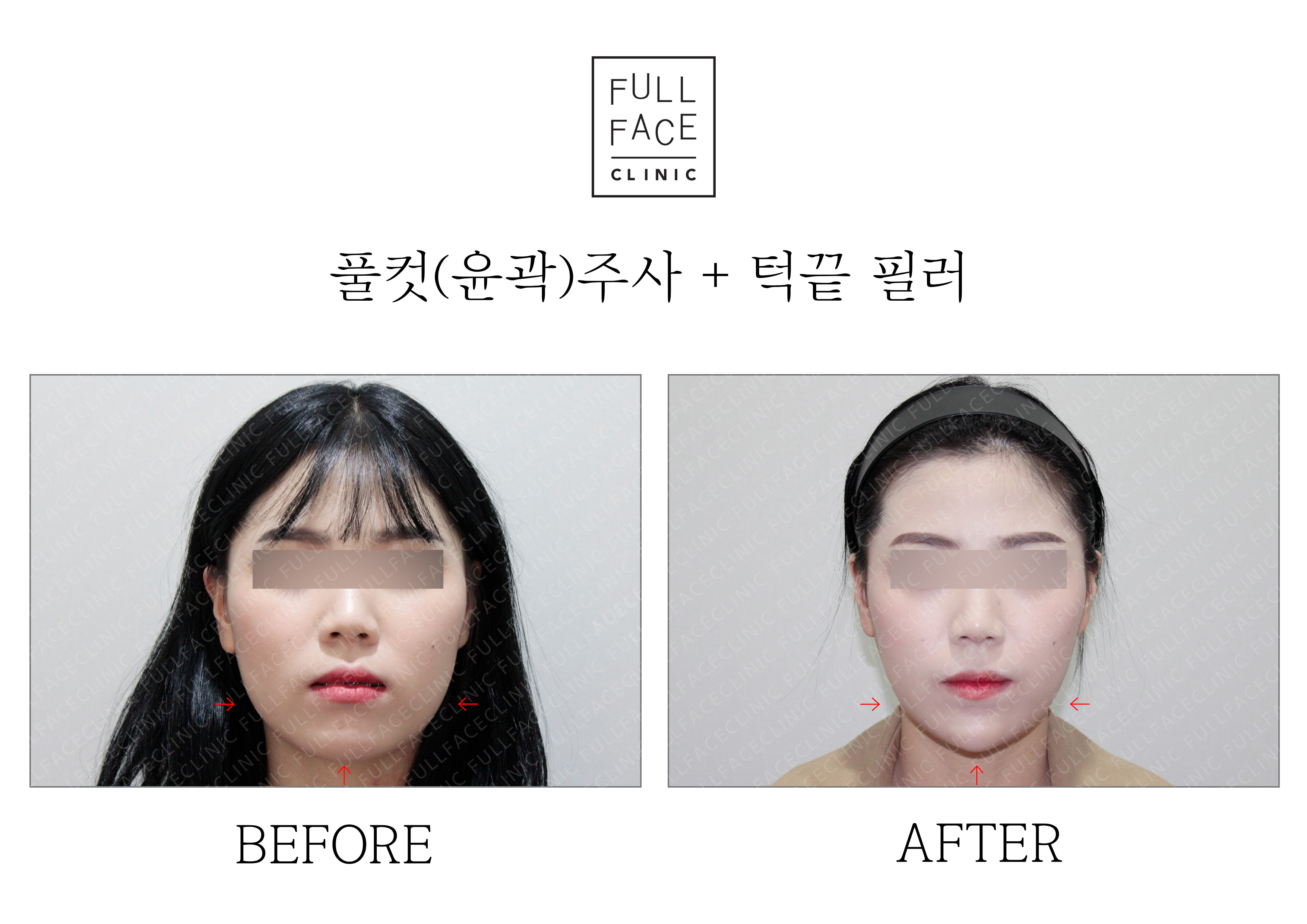 Contour treatment before and after case