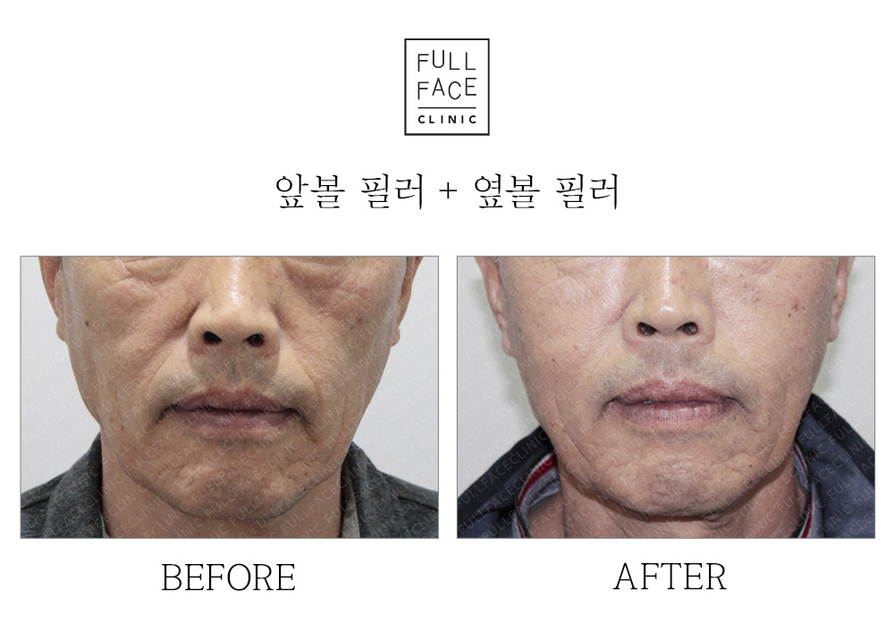 Before and after filler case