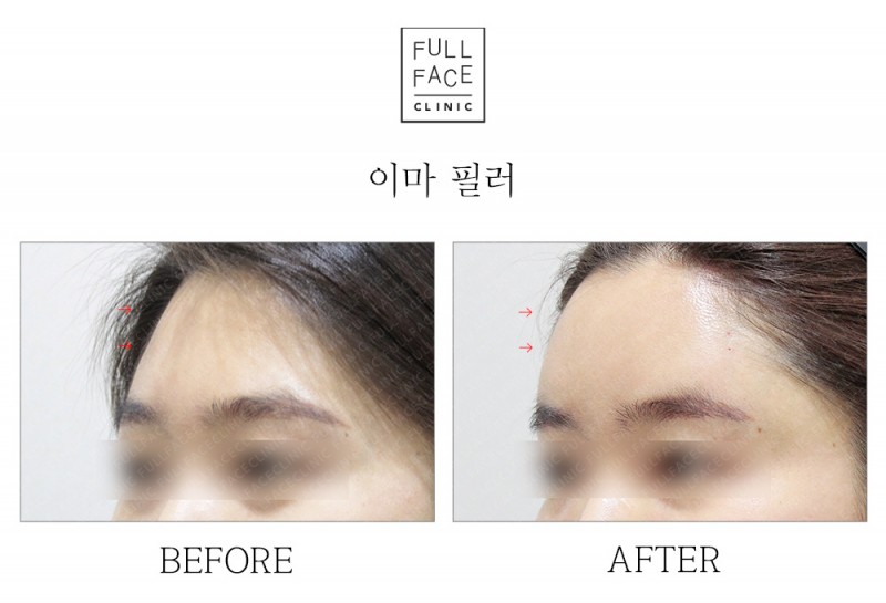 Filler