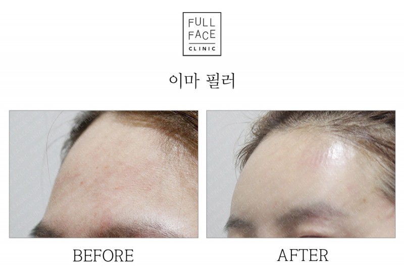 Filler
