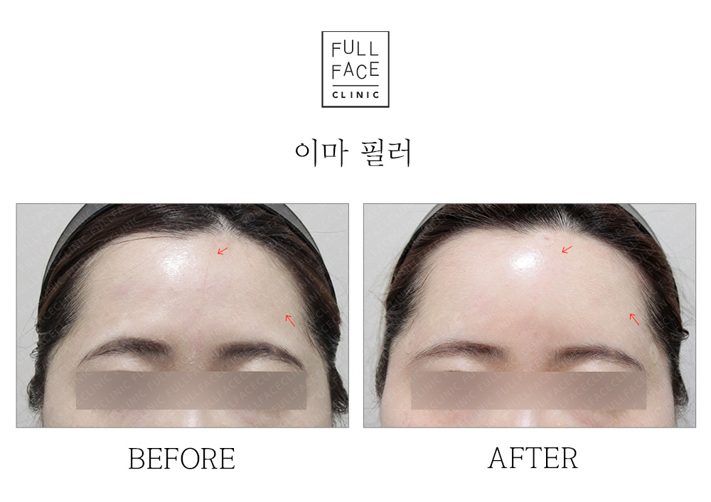 Filler