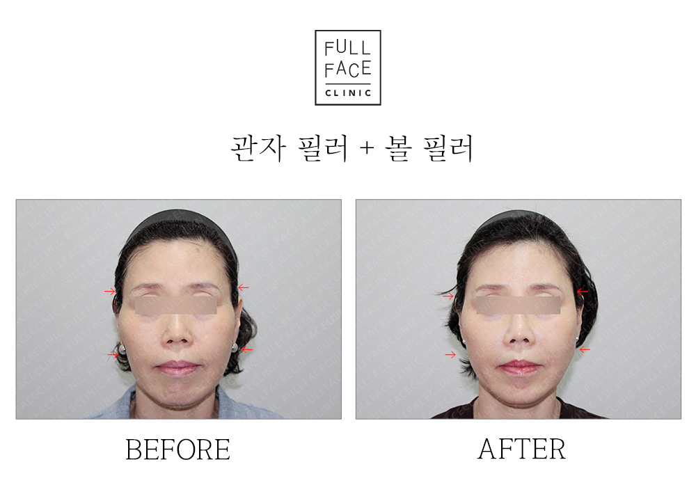 Filler