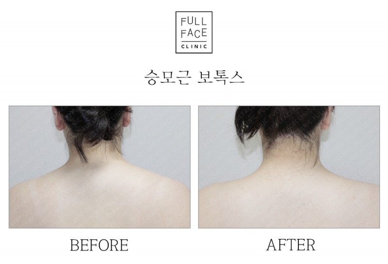 승모근보톡스(19.10.21→20.2.29)