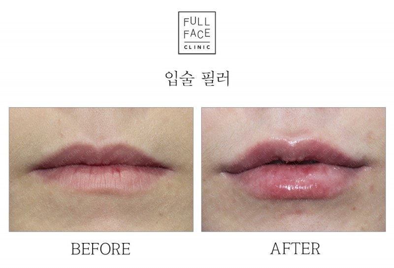 입술필러(19.9.7→19.12.14)