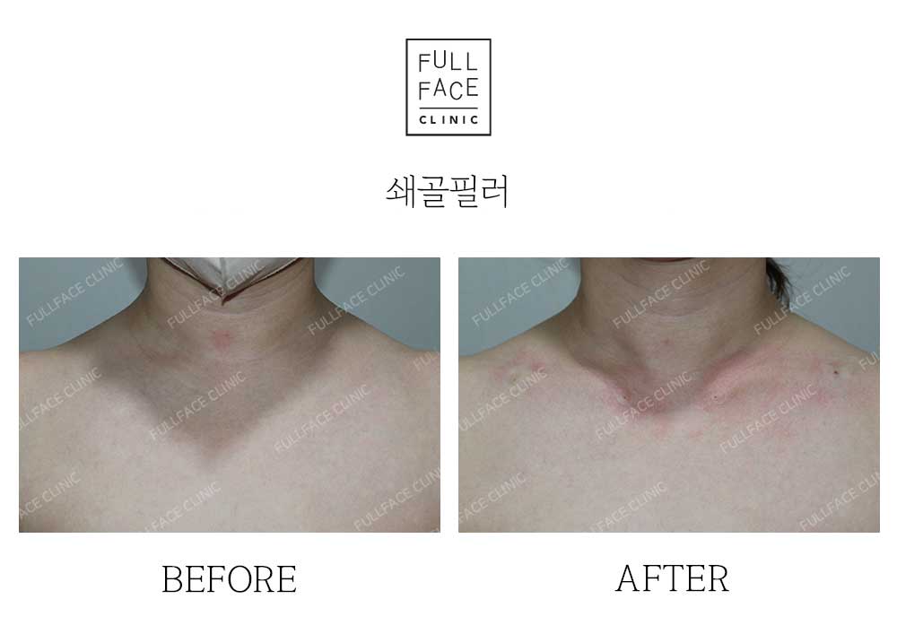 Filler