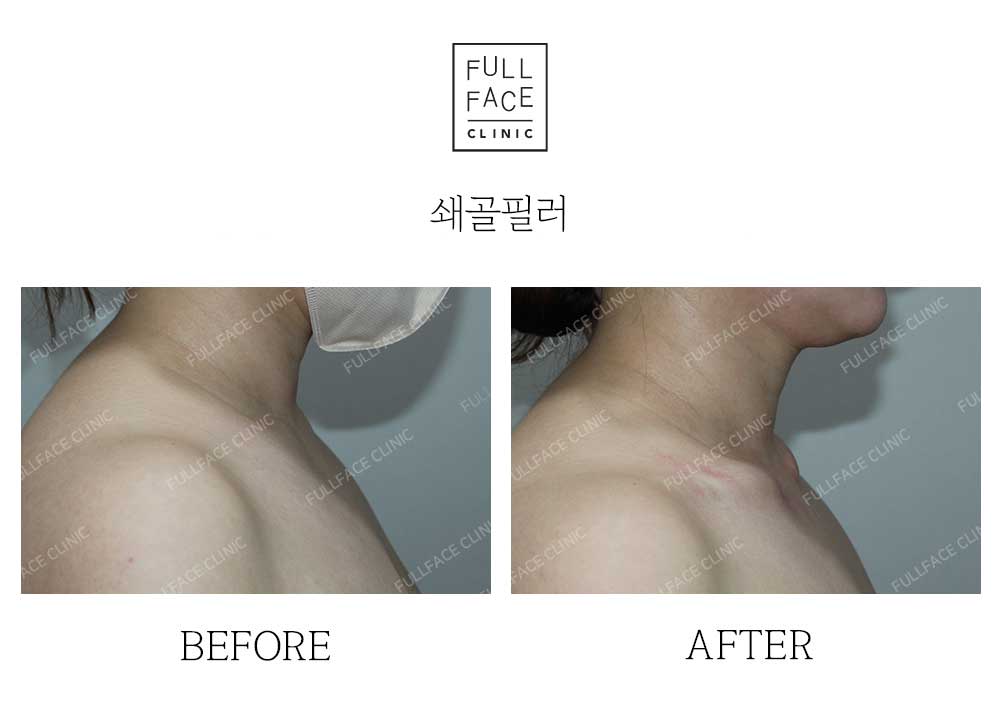 Filler