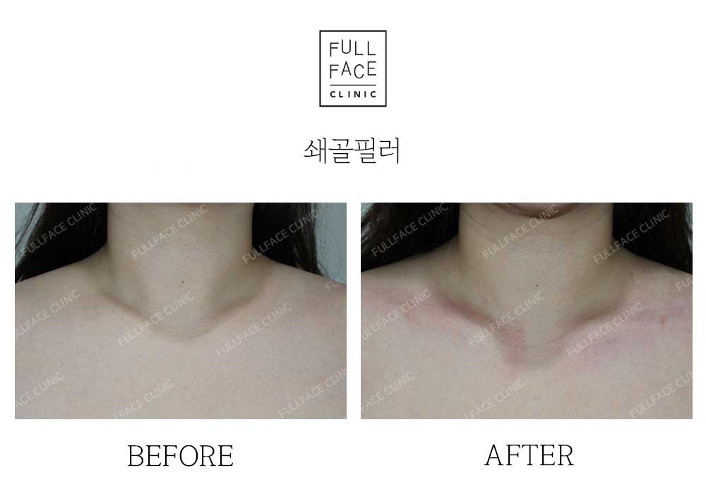 Filler