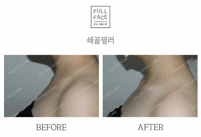 Filler