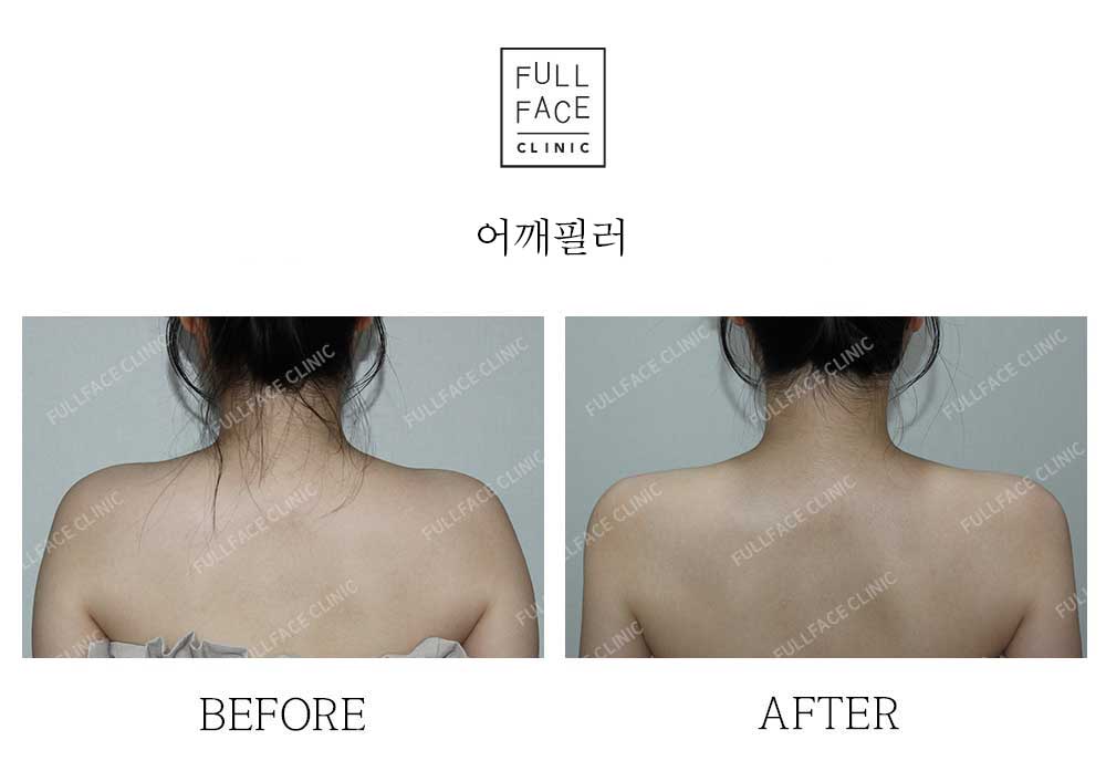 Filler
