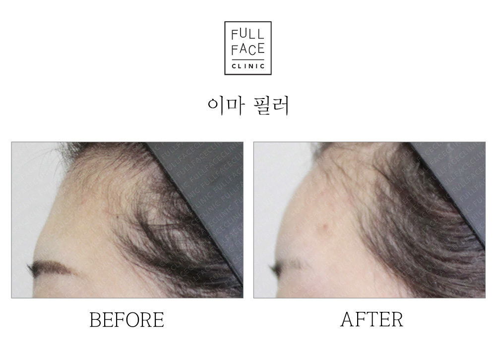이마필러 잘하는곳, ㅇㅇ 꼭 확인하고 가세요. 신촌 피부과